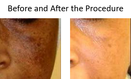 Before and After Image Gallery | Skin Treatments Dubai