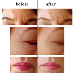face-fine-lines-and-wrinkles-Botox